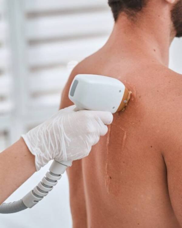 No.1 and Best Laser Hair Removal in Bangalore at Aurilueur.
