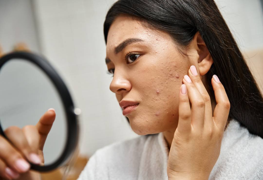 Expert acne and scar treatment in Bangalore with Aurilueur