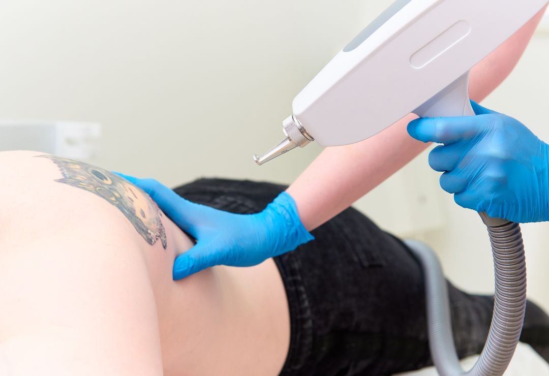 Laser Tattoo Removal Treatment in Bangalore at Aurilueur Esthetic Clinic