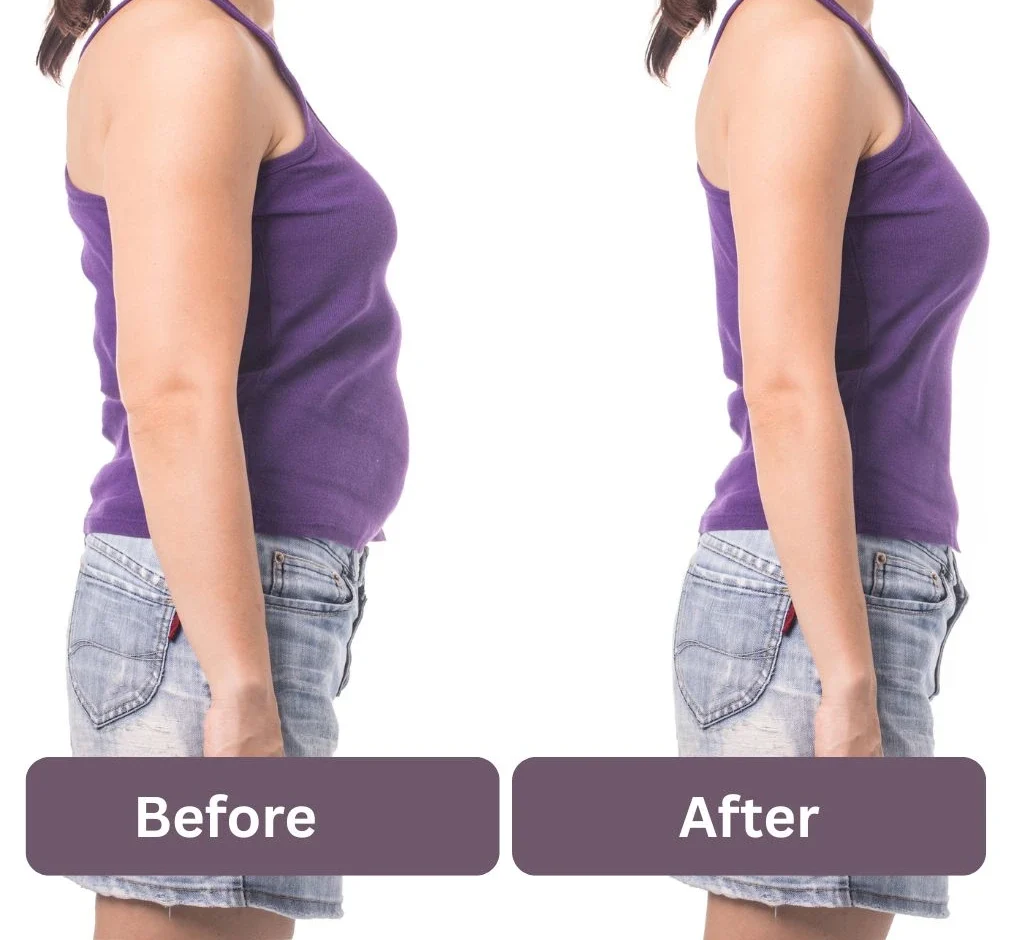 Coolsculpting in Bangalore session showing cryolipolysis fat freezing treatment on abdomen