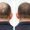 GFC Hair Treatment in Bangalore for visible hair regrowth