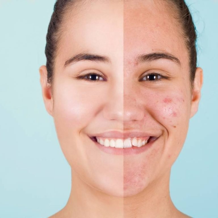 Aurilueur No.1 acne treatment clinic in Bangalore for clear skin