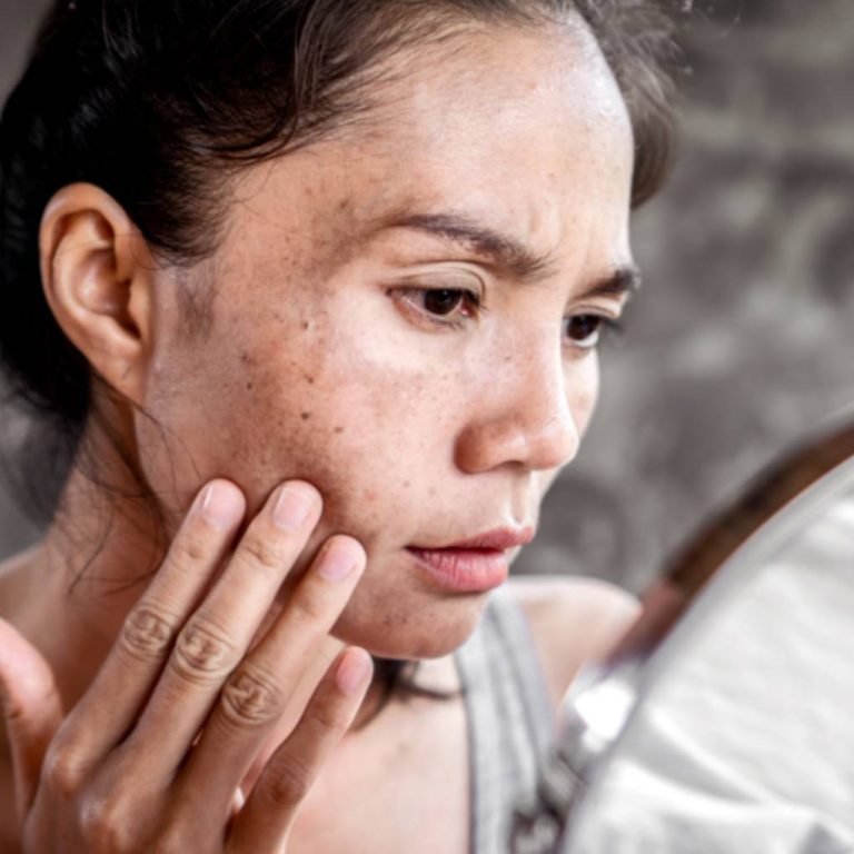 Best Sun Damaged Skin Treatment on Body at Aurilueur for clear skin.