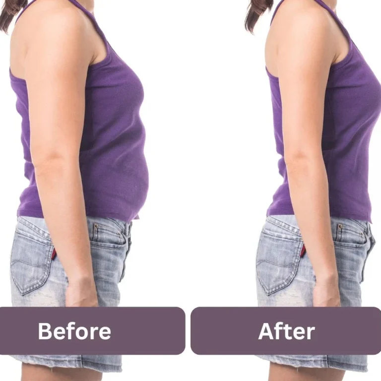 Coolsculpting in Bangalore session showing cryolipolysis fat freezing treatment on abdomen